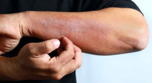 The-effect-of-several-medicinal-plants-on-the-treatment-of-skin-diseases